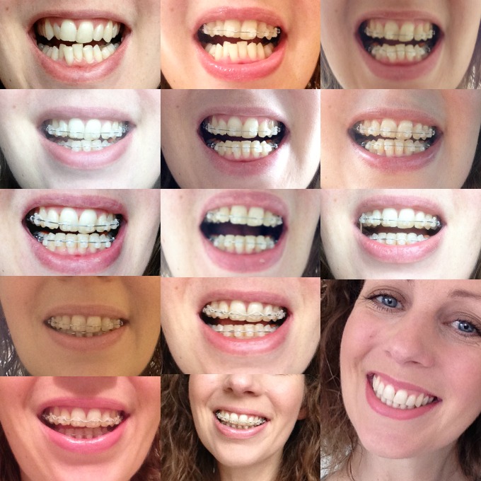 Braces: before, during and after